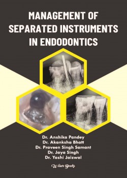 Management of Separated Instruments in Endodontics